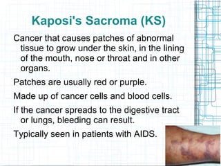 Lymphoma is the cancer of lymph tissue found in lymph nodes, spleen, liver and bone marrow. 
