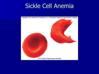 Sickle Cell Anemia 