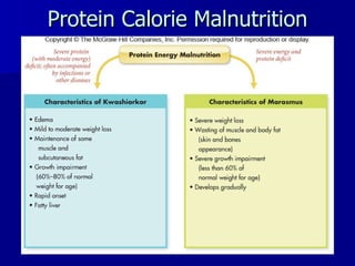 Protein Calorie Malnutrition 