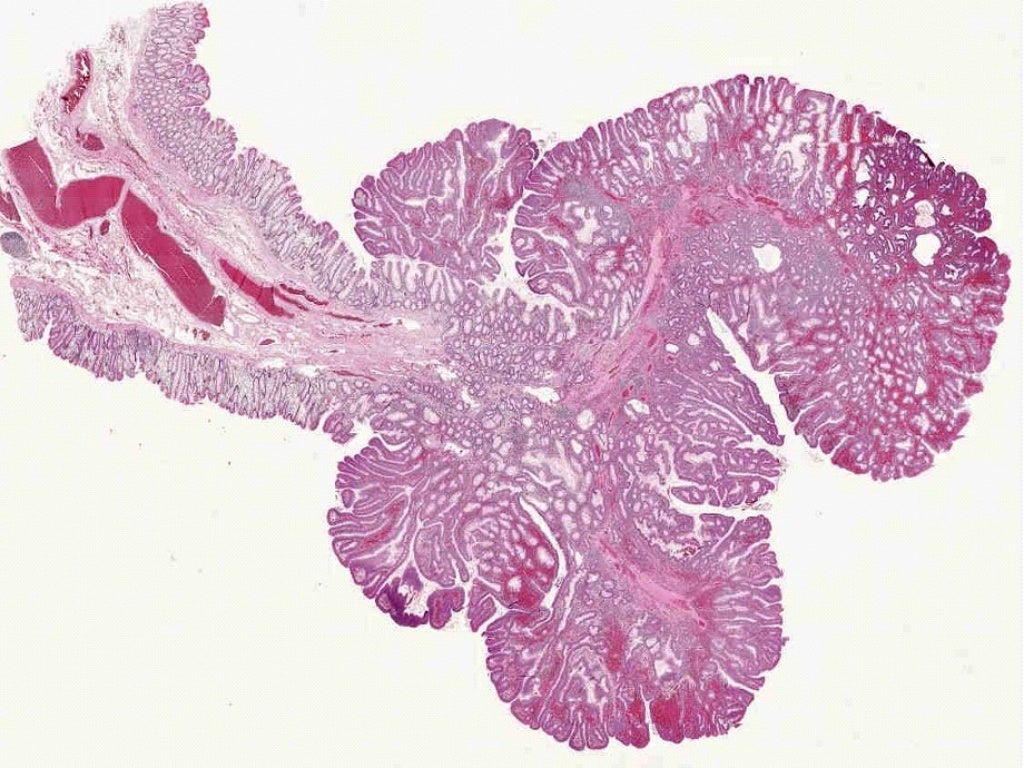 neoplasia