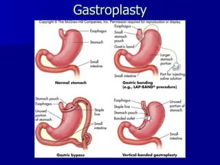 Gastroplasty 