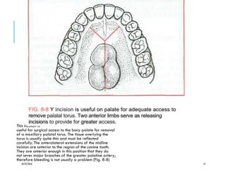 This incision is
useful for surgical access to the bony palate for removal
of a maxillary palatal torus. The tissue overlying the
torus is usually quite thin and must be reflected
carefully. The anterolateral extensions of the midline
incision are anterior to the region of the canine tooth.
They are anterior enough in this position that they do
not sever major branches of the greater palatine artery;
therefore bleeding is not usually a problem (Fig. 8-8)
10/22/2016 15
 