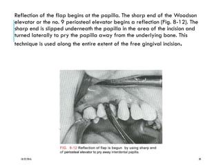 Reflection of the flap begins at the papilla. The sharp end of the Woodson
elevator or the no. 9 periosteal elevator begins a reflection (Fig. 8-12). The
sharp end is slipped underneath the papilla in the area of the incision and
turned laterally to pry the papilla away from the underlying bone. This
technique is used along the entire extent of the free gingival incision.
10/22/2016 20
 