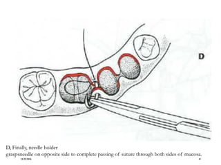 D, Finally, needle holder
graspsneedle on opposite side to complete passing of suture through both sides of mucosa.
10/22/2016 41
 