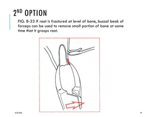 2ND OPTION
FIG. 8-33 If root is fractured at level of bone, buccal beak of
forceps can be used to remove small portion of bone at same
time that it grasps root.
10/22/2016 49
 