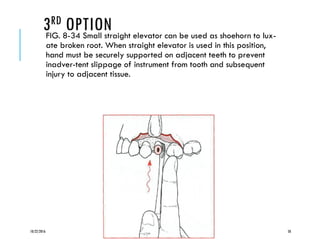 3RD OPTIONFIG. 8-34 Small straight elevator can be used as shoehorn to lux-
ate broken root. When straight elevator is used in this position,
hand must be securely supported on adjacent teeth to prevent
inadver-tent slippage of instrument from tooth and subsequent
injury to adjacent tissue.
10/22/2016 50
 