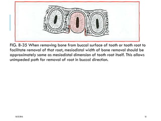 FIG. 8-35 When removing bone from buccal surface of tooth or tooth root to
facilitate removal of that root, mesiodistal width of bone removal should be
approximately same as mesiodistal dimension of tooth root itself. This allows
unimpeded path for removal of root in buccal direction.
10/22/2016 53
 