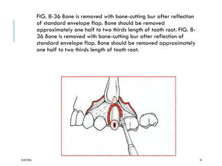 FIG. 8-36 Bone is removed with bone-cutting bur after reflection
of standard envelope flap. Bone should be removed
approximately one half to two thirds length of tooth root. FIG. 8-
36 Bone is removed with bone-cutting bur after reflection of
standard envelope flap. Bone should be removed approximately
one half to two thirds length of tooth root.
10/22/2016 54
 