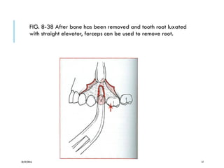 FIG. 8-38 After bone has been removed and tooth root luxated
with straight elevator, forceps can be used to remove root.
10/22/2016 57
 