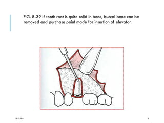 FIG. 8-39 If tooth root is quite solid in bone, buccal bone can be
removed and purchase point made for insertion of elevator.
10/22/2016 58
 