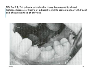 FIG. 8-42 A, This primary second molar cannot be removed by closed
technique because of tipping of adjacent teeth into occlusal path of withdrawal
and of high likelihood of ankylosis.
10/22/2016 63
 