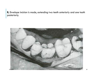 B, Envelope incision is made, extending two teeth anteriorly and one tooth
posteriorly.
10/22/2016 64
 