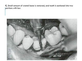 C, Small amount of crestal bone is removed, and tooth is sectioned into two
portions with bur.
10/22/2016 65
 