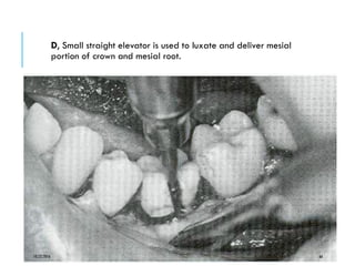 D, Small straight elevator is used to luxate and deliver mesial
portion of crown and mesial root.
10/22/2016 66
 