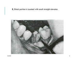 E, Distal portion is luxated with small straight elevator.
10/22/2016 67
 
