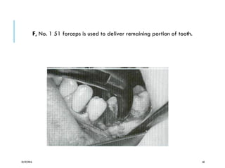 F, No. 1 51 forceps is used to deliver remaining portion of tooth.
10/22/2016 68
 