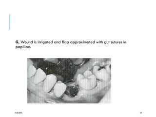 G, Wound is irrigated and flap approximated with gut sutures in
papillae.
10/22/2016 69
 