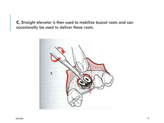 C, Straight elevator is then used to mobilize buccal roots and can
occasionally be used to deliver these roots.
10/22/2016 74
 