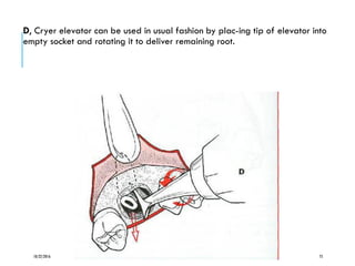 D, Cryer elevator can be used in usual fashion by plac-ing tip of elevator into
empty socket and rotating it to deliver remaining root.
10/22/2016 75
 