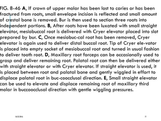 FIG. 8-46 A, If crown of upper molar has been lost to caries or has been
fractured from roots, small envelope incision is reflected and small amount
of crestal bone is removed. Bur is then used to section three roots into
independent portions. B, After roots have been luxated with small straight
elevator, mesiobuccal root is delivered with Cryer elevator placed into slot
prepared by bur. C, Once mesiobuc-cal root has been removed, Cryer
elevator is again used to deliver distal buccal root. Tip of Cryer ele-vator
is placed into empty socket of mesiobuccal root and turned in usual fashion
to deliver tooth root. D, Maxillary root forceps can be occasionally used to
grasp and deliver remaining root. Palatal root can then be delivered either
with straight elevator or with Cryer elevator. If straight elevator is used, it
is placed between root and palatal bone and gently wiggled in effort to
displace palatal root in buc-coocclusal direction. E, Small straight elevator
can be used to elevate and displace remaining root of maxillary third
molar in buccoocclusal direction with gentle wiggling pressures.
10/22/2016 77
 