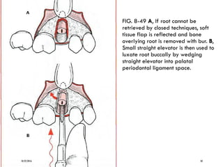 FIG. 8-49 A, If root cannot be
retrieved by closed techniques, soft
tissue flap is reflected and bone
overlying root is removed with bur. B,
Small straight elevator is then used to
luxate root buccally by wedging
straight elevator into palatal
periodontal ligament space.
10/22/2016 82
 