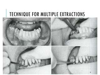 TECHNIQUE FOR MULTIPLE EXTRACTIONS
10/22/2016 92
 