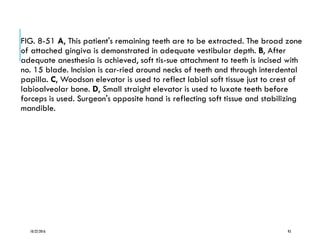 FIG. 8-51 A, This patient's remaining teeth are to be extracted. The broad zone
of attached gingiva is demonstrated in adequate vestibular depth. B, After
adequate anesthesia is achieved, soft tis-sue attachment to teeth is incised with
no. 15 blade. Incision is car-ried around necks of teeth and through interdental
papilla. C, Woodson elevator is used to reflect labial soft tissue just to crest of
labioalveolar bone. D, Small straight elevator is used to luxate teeth before
forceps is used. Surgeon's opposite hand is reflecting soft tissue and stabilizing
mandible.
10/22/2016 93
 