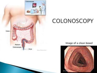COLONOSCOPYImage of a clean bowel