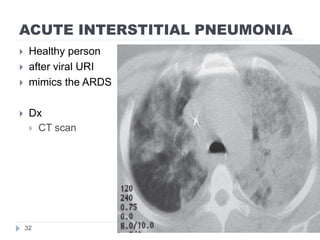 ACUTE INTERSTITIAL PNEUMONIA
2014-07-1132
 Healthy person
 after viral URI
 mimics the ARDS
 Dx
 CT scan
 