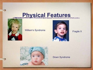 Physical Features William’s Syndrome Fragile X Down Syndrome 
