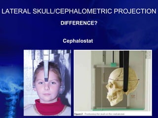 LATERAL SKULL/CEPHALOMETRIC PROJECTION
DIFFERENCE?
Cephalostat
 