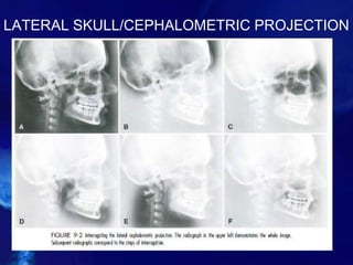 LATERAL SKULL/CEPHALOMETRIC PROJECTION
 