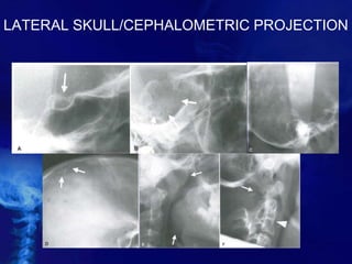 LATERAL SKULL/CEPHALOMETRIC PROJECTION
 