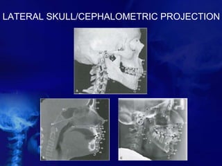 LATERAL SKULL/CEPHALOMETRIC PROJECTION
 