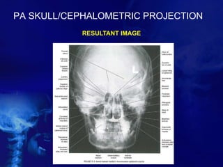 PA SKULL/CEPHALOMETRIC PROJECTION
RESULTANT IMAGE
 