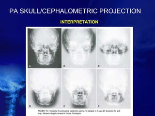 PA SKULL/CEPHALOMETRIC PROJECTION
INTERPRETATION
 