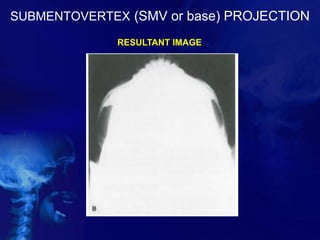 SUBMENTOVERTEX (SMV or base) PROJECTION
RESULTANT IMAGE
 
