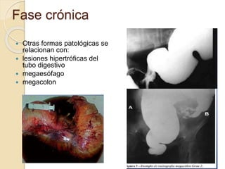 Fase crónica
 Otras formas patológicas se
relacionan con:
 lesiones hipertróficas del
tubo digestivo
 megaesófago
 megacolon
 