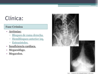 Clínica:
• Arritmias:
▫ Bloqueo de rama derecha.
▫ Hemibloqueo anterior izq.
▫ Extrasístoles.
• Insuficiencia cardiaca.
• Megaesófago.
• Megacolon.
Fase Crónica
 