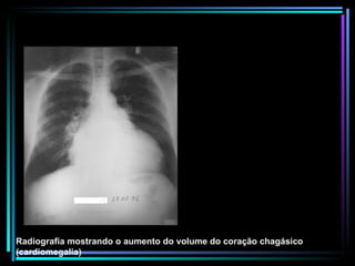 Radiografia mostrando o aumento do volume do coração chagásico (cardiomegalia) 