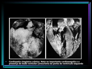 Cardiopatia chagásica crônica. Nota-se importante cardiomegalia e a presença de lesão vorticilar (aneurisma da ponta do ventrículo esquerdo 