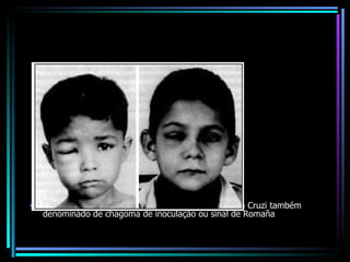 Edema palpebral, porta de entrada do Trypanosoma Cruzi também denominado de chagoma de inoculação ou sinal de Romaña  