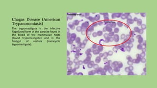 Chagas Disease (American
Trypanosomiasis)
The trypomastigote is the infective
flagellated form of the parasite found in
the blood of the mammalian hosts
(blood trypomastigote) and in the
hindgut of vectors (metacyclic
trypomastigote).
 