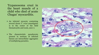 Trypanosoma cruzi in
the heart muscle of a
child who died of acute
Chagas’ myocarditis.
 An infected myocyte containing
several dozen T. cruzi amastigotes
is in the center of the field
(hematoxylin and eosin, 900×).
 The characteristic pseudocysts
present in sections of infected
tissues are intracellular aggregates
of multiplying parasites.
 