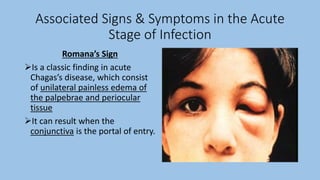 Associated Signs & Symptoms in the Acute
Stage of Infection
Romana’s Sign
Is a classic finding in acute
Chagas’s disease, which consist
of unilateral painless edema of
the palpebrae and periocular
tissue
It can result when the
conjunctiva is the portal of entry.
 