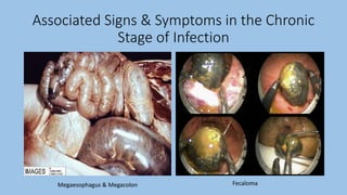 Associated Signs & Symptoms in the Chronic
Stage of Infection
Megaesophagus & Megacolon Fecaloma
 