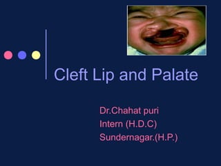 Cleft Lip and Palate

      Dr.Chahat puri
      Intern (H.D.C)
      Sundernagar.(H.P.)
 