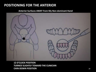 POSITIONING FOR THE ANTERIOR
Anterior Surfaces AWAY From My Non-dominant Hand
12 O’CLOCK POSITION
TURNED SLIGHTLY TOWARD THE CLINICIAN
CHIN-DOWN POSITION 28
 