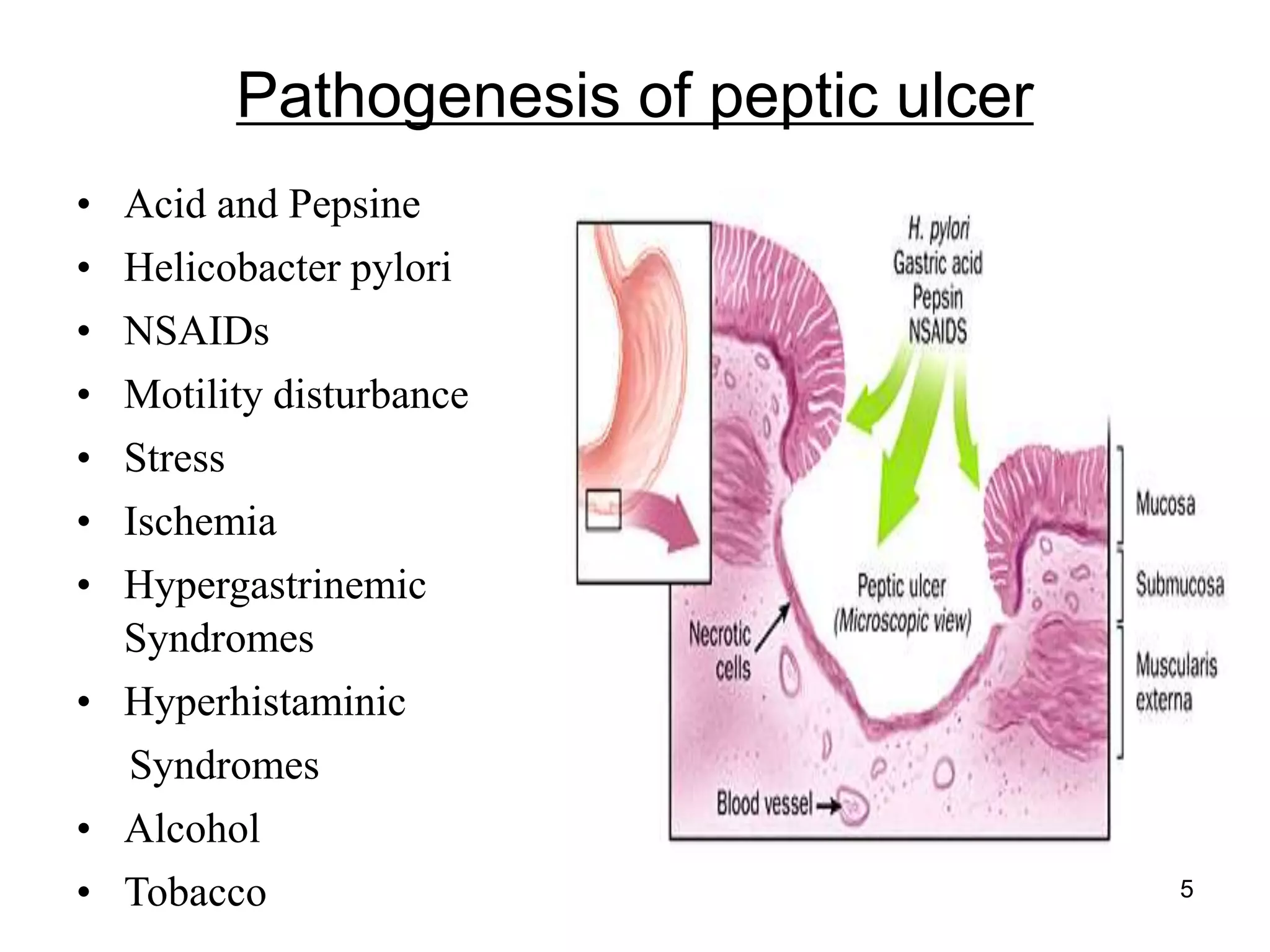 Pathogenesis of peptic ulcer
• Acid and Pepsine
• Helicobacter pylori
• NSAIDs
• Motility disturbance
• Stress
• Ischemia
• Hypergastrinemic
Syndromes
• Hyperhistaminic
Syndromes
• Alcohol
• Tobacco 5
 