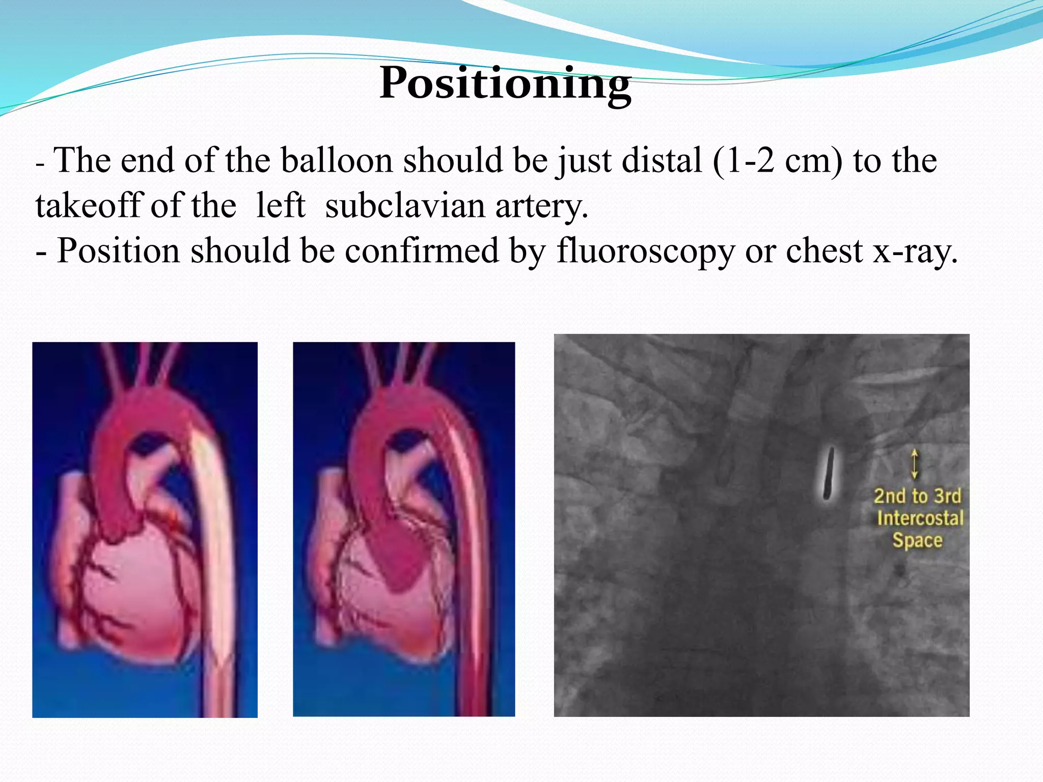 Positioning
- The end of the balloon should be just distal (1-2 cm) to the
takeoff of the left subclavian artery.
- Position should be confirmed by fluoroscopy or chest x-ray.
 